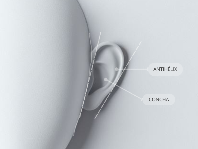 Zonas clave de la oreja Clipping