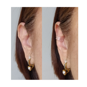 Cliente usando corrector de orejas Clipping Transparente