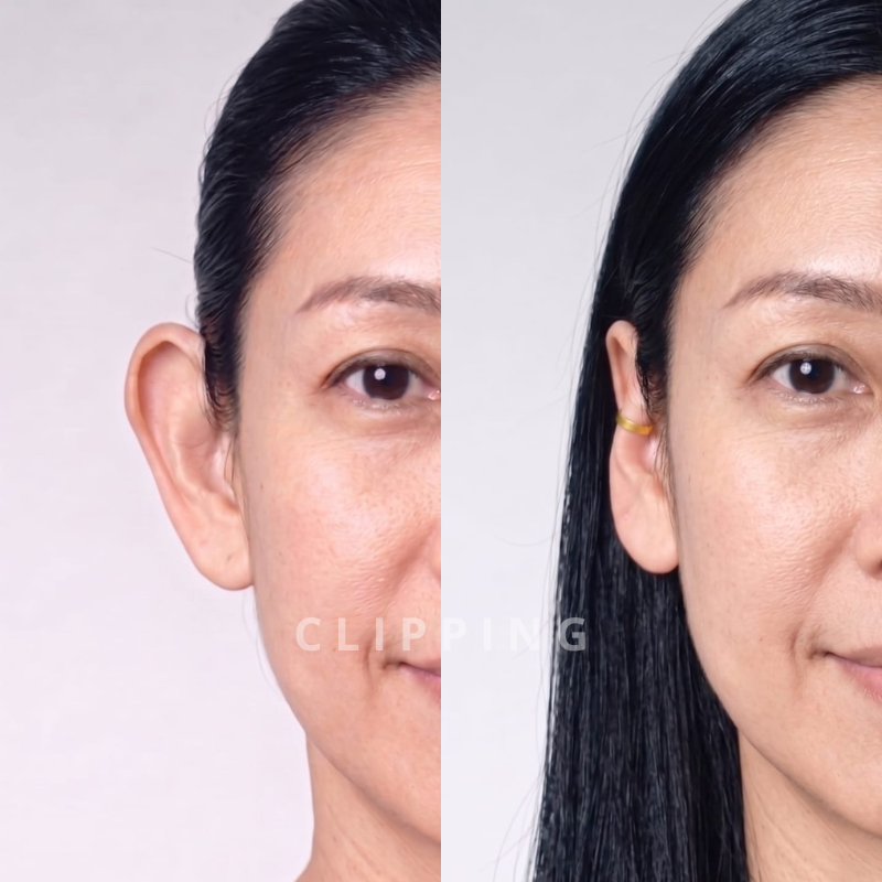 Paso 3: corrector de orejas Clipping® colocado correctamente