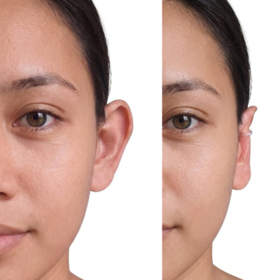 Cliente usando el corrector de orejas Clipping® 4